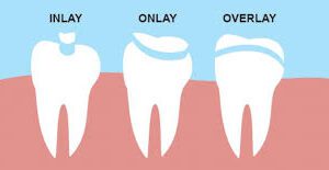 Inley ve Onley Diş Restorasyonları